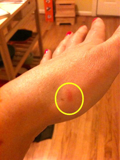 thumb-burn-1-ff94f5b146158f30ae4de7fdad135f74