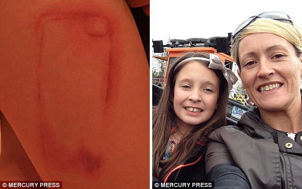 Nine-year-old Olivia Retter (right) got a chemical burn from her iPhone case. Ouch.