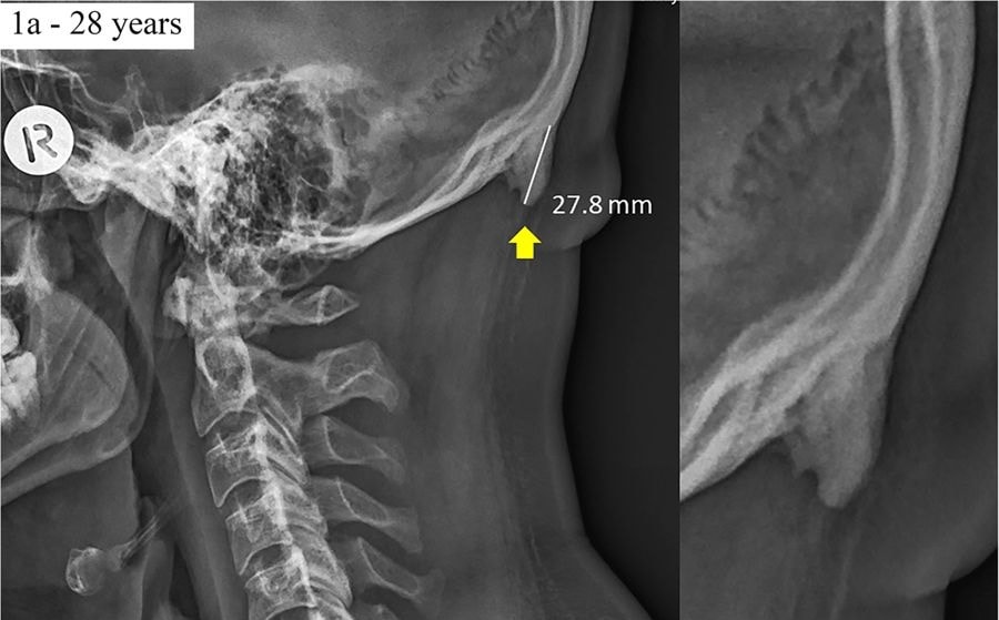 Not a horn, an enlarged external occipital protuberance (EEOP)